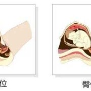 胎儿头位和臀位的区别（什么是臀位d）