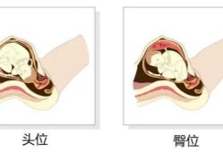 胎儿头位和臀位的区别（什么是臀位d）