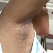 孕期腋窝变黑怎么回事（怀孕腋下变黑怎么办）