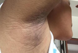 孕期腋窝变黑怎么回事（怀孕腋下变黑怎么办）