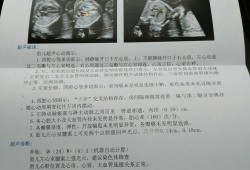 胎儿心脏结构（刚满月的宝宝做的心脏彩超,左室条索是怎么回事,严重吗）