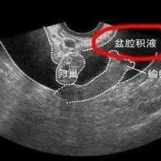 孕期盆腔积液（孕期盆腔积液）