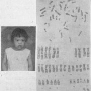 胎儿染色体畸形（胎儿染色体畸形是什么原因）