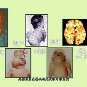 出生15天的宝宝金葡菌血液感染，这病严重吗,胎儿感染弓形虫的症状