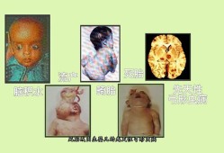 出生15天的宝宝金葡菌血液感染，这病严重吗,胎儿感染弓形虫的症状