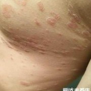 孕期玫瑰糠疹（玫瑰糠疹的治疗方法有哪些）