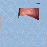孕期尖锐湿庞（孕期尖锐湿庞能根治吗）