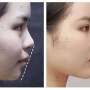 胎儿下颚短小（什么样的下巴属于短的）