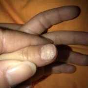 胎儿指甲划（胎儿指甲划子宫）
