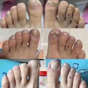 孕期灰指甲（孕期灰指甲怎么治疗最好）