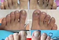 孕期灰指甲（孕期灰指甲怎么治疗最好）