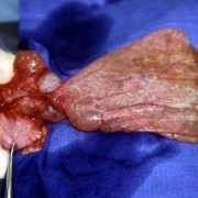 胎儿肠系膜囊肿（胎儿肠系膜囊肿会被吸收吗）
