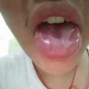 孕期舌头花（孕期舌头花一块白一块）