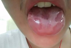 孕期舌头花（孕期舌头花一块白一块）