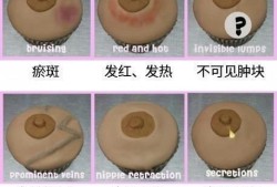怀孕后乳头痒怎么办,孕期乳晕痒怎么回事儿
