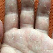 孕妇脸脱皮怎么回事,孕期手脱皮怎么回事儿