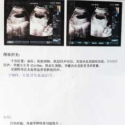 胎儿肾分离是什么意思（B超显示胎儿双肾集合系统分离是怎么回事）