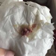 孕妇鼻屎多怎么回事,孕期鼻屎多怎么回事,而且还有血丝