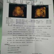 25周的胎儿有多重（25周多了，四维彩超说NF增厚是什么意思）