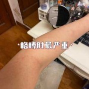 孕期湿疹（孕期湿疹止痒最有效的方法）