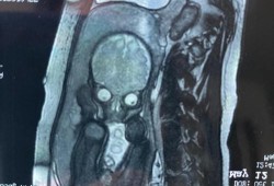 胎儿脊柱裂做核磁能查么,胎儿几个月不会畸形了