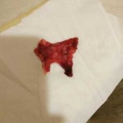 怀孕期间少量出血（怀孕期间少量出血正常吗）