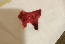 怀孕期间少量出血（怀孕期间少量出血正常吗）