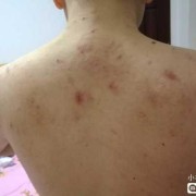 孕期长湿疹影响胎儿吗（孕妇在怀孕期间起湿疹对胎儿有影响吗）