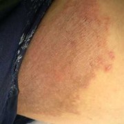 孕期湿疹如何护理（孕期长湿疹怎么办?手肘部和腹股沟有些痒，肚皮上也有）