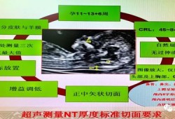 胎儿nt增厚什么意思（ntlf厚代表什么）