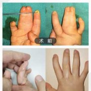 如何预防胎儿手脚畸形（胎儿四肢短小该怎么办啊）