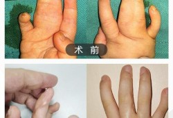 如何预防胎儿手脚畸形（胎儿四肢短小该怎么办啊）