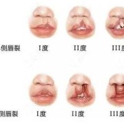 胎儿兔唇怎么办（胎儿兔唇是什么原因造成的）