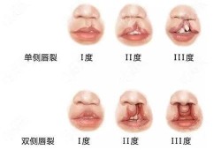 胎儿兔唇怎么办（胎儿兔唇是什么原因造成的）