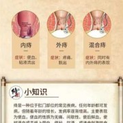 孕期外痔（孕期长痔疮怎么治疗）