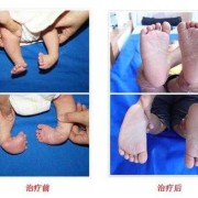 胎儿左足内翻怎么办（新生儿轻微脚内翻是怎么回事呢）