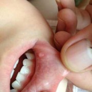 胎儿嘴唇裂（婴儿嘴巴热怎么办呢？是发烧的症状吗）