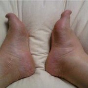 孕妇下肢浮肿的原因，孕期小腿浮肿怎么办,孕期脸浮肿是什么原因引起的
