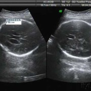 孕期胎儿侧脑室积液（胎儿双侧侧脑室前角外侧可见液性暗区怎么回事）