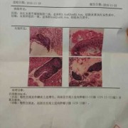 孕期宫颈增生（宫颈鳞状上皮增生怎么治疗）