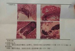 孕期宫颈增生（宫颈鳞状上皮增生怎么治疗）