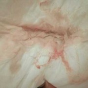 孕期保胎（怀孕身上出了好多血，保胎对胎儿健康有影响吗）