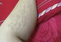 小腿胖的女生可以穿什么样的连衣裙,孕期小腿肥胖纹图片