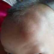 怀孕胎儿靠左边（3岁小孩孩子头左侧中部摔了个大包怎么办）