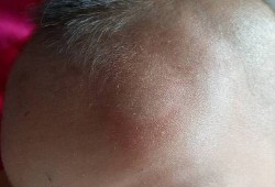 怀孕胎儿靠左边（3岁小孩孩子头左侧中部摔了个大包怎么办）