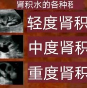 胎儿肾积水引产人多吗（胎儿肾积水跟孕妇生气有关系吗）