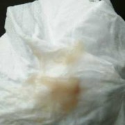 孕期白带粘稠像鼻涕