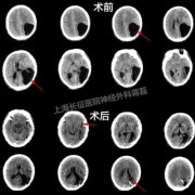 胎儿蛛网膜囊肿能要吗（胎儿蛛网膜囊肿该不该生下来）