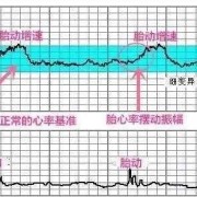 胎儿心率不齐是怎么引起的怎么办,胎儿心率不稳定忽高忽低