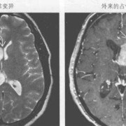 胎儿脑室不对称（胎儿脑室不对称有什么影响）
